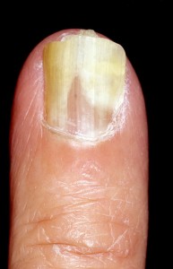 лечение ногтевого грибка в домашних условиях